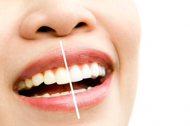 Com clareamento dental, seu sorriso fica ainda mais bonito!