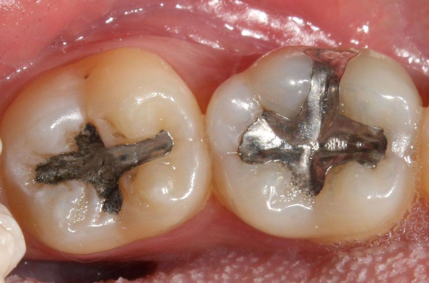 Amálgama dental pode ser perigoso para a saúde: saiba mais