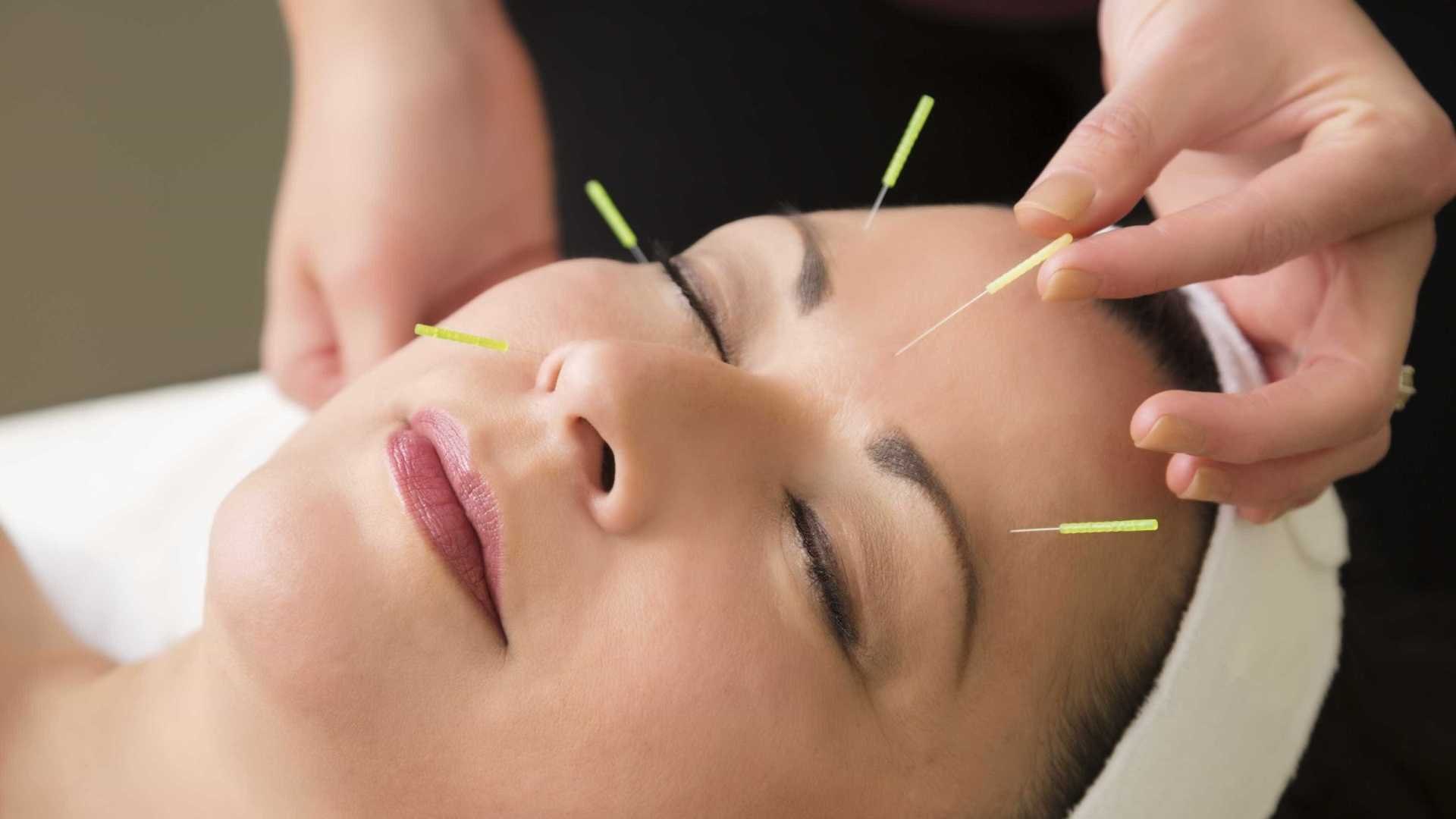 Acupuntura na odontologia