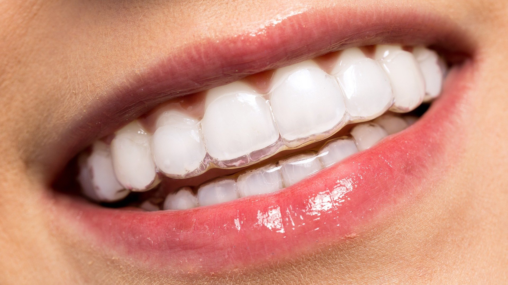 Estética dental · Apóllon Odontologia