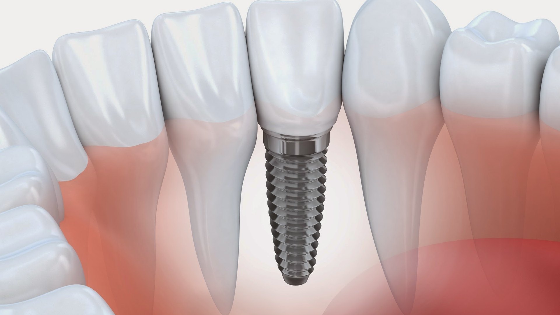 Implantes cerâmicos · Apóllon Odontologia