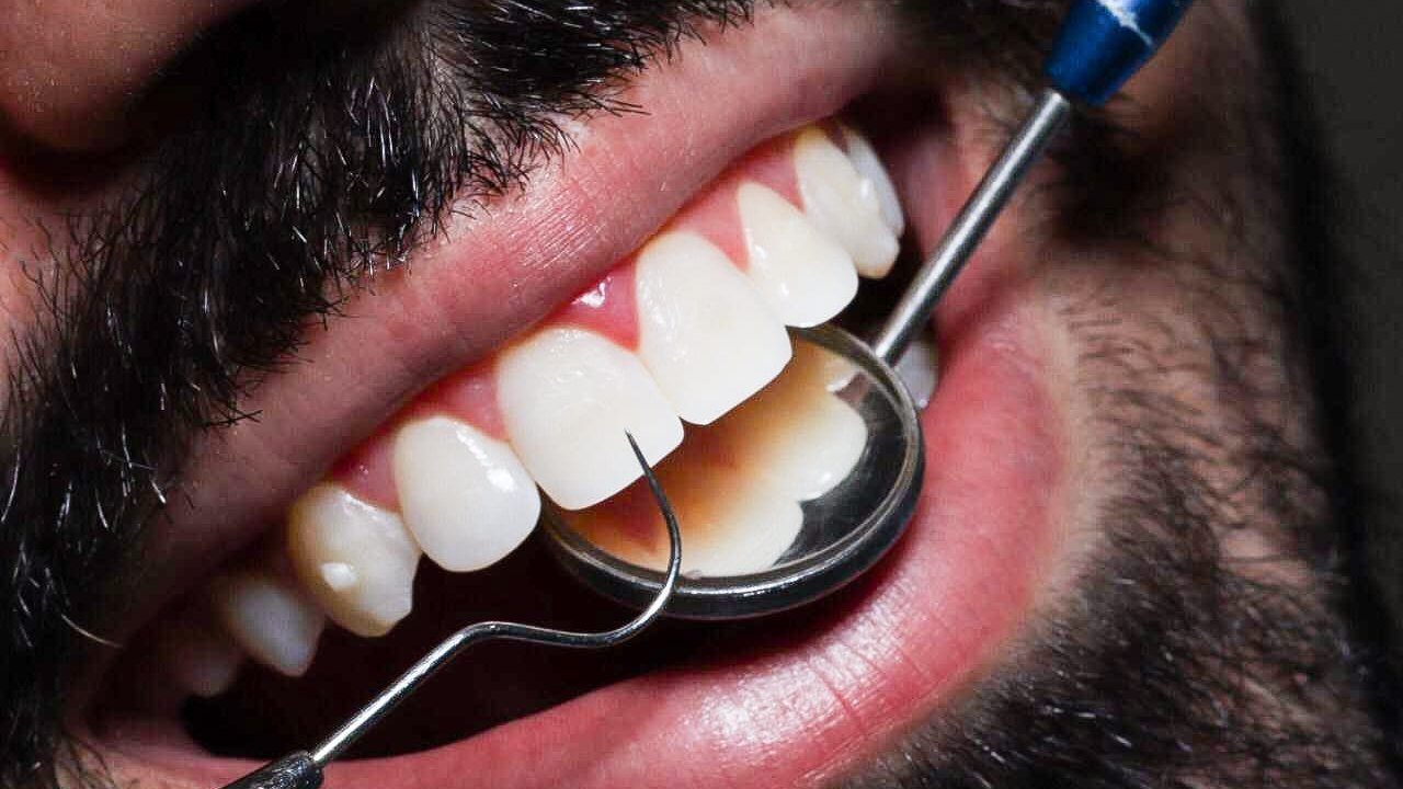 Profilaxia dental em Cascavel