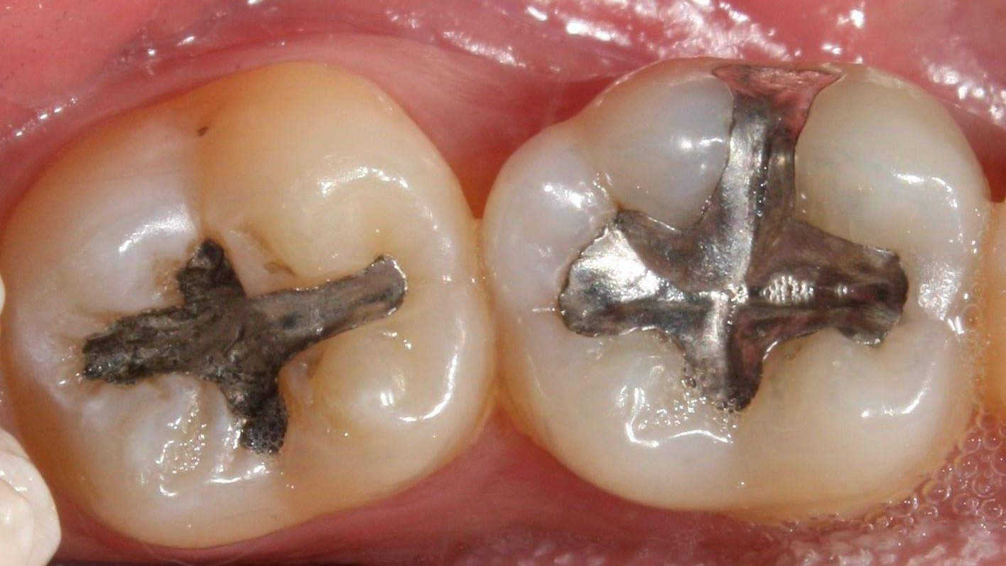 Remoção segura de amálgama · Apóllon Odontologia