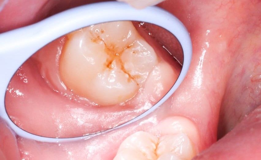 Dentista atendendo paciente em Cascavel - PR para avaliação de selamento biológico